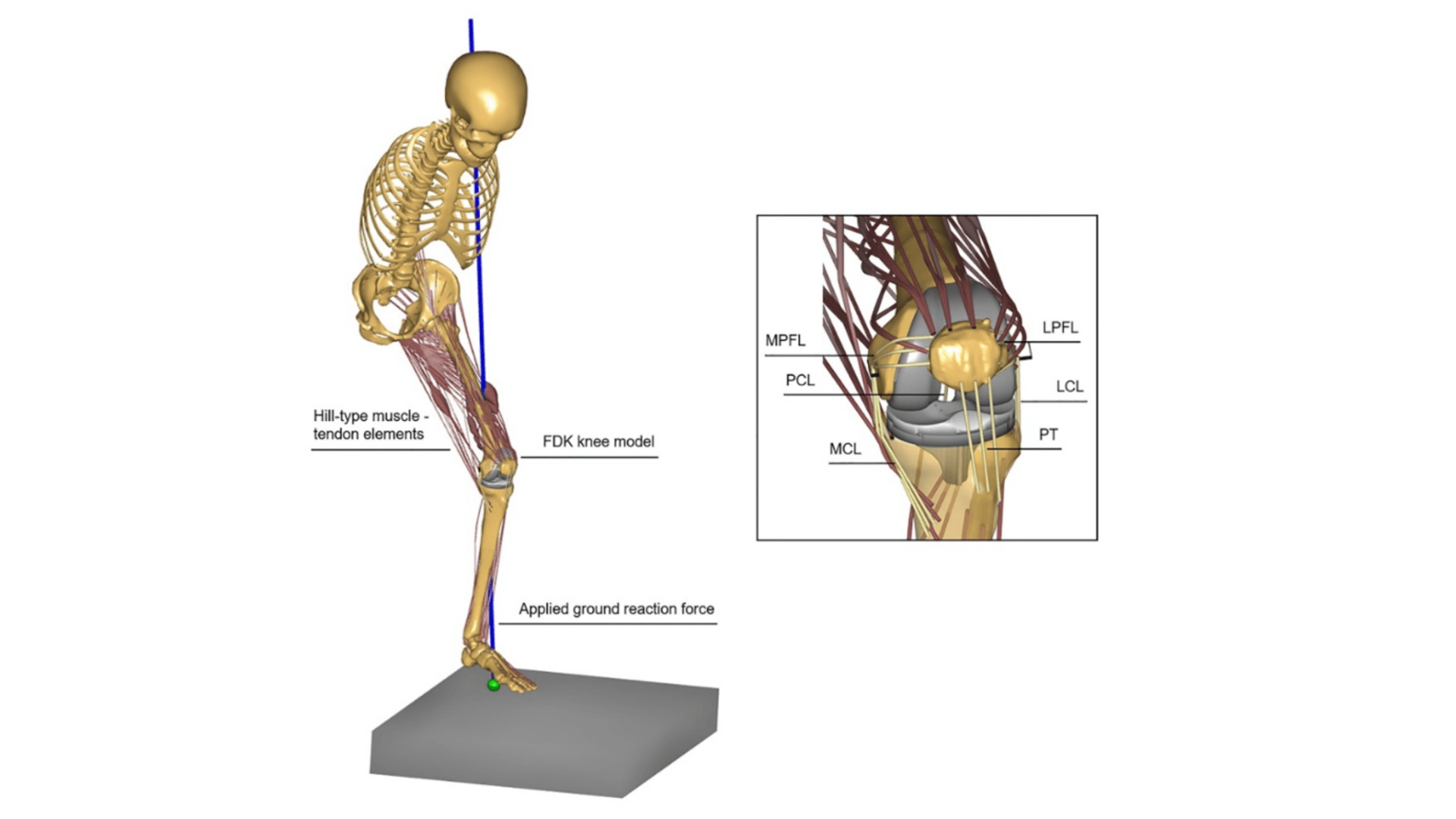 A model-based methodology to predict the biomechanical consequences of tibial insert thickness after total knee arthroplasty