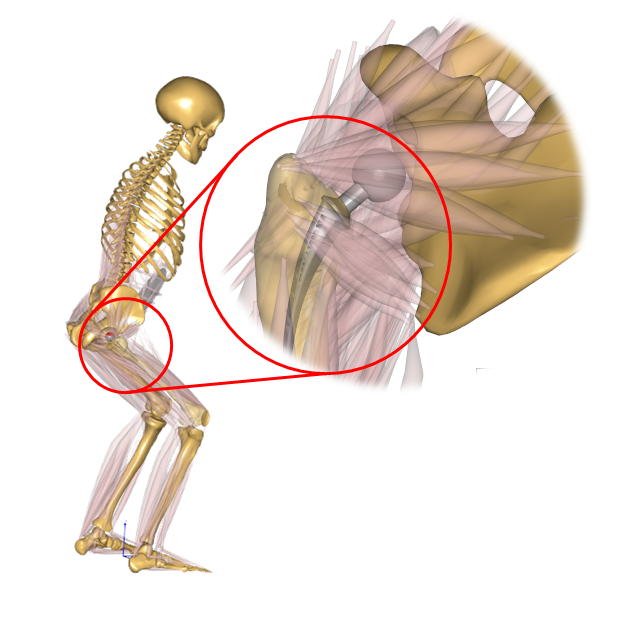 Total Hip Arthoplasty