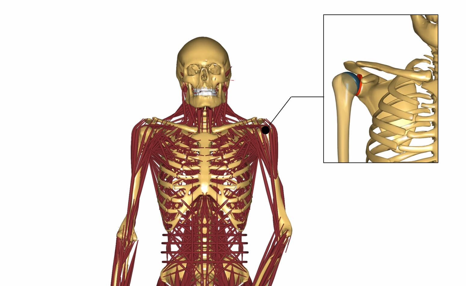 shoulder implant