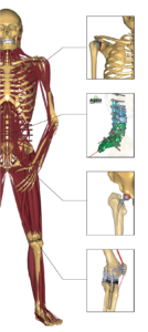 AnyBody model with orthopaedic implants